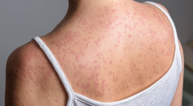 伦敦北部麻疹疫情蔓延，未接种疫苗儿童成高危群体